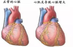 病毒性心肌炎的症状,识别与应对指南