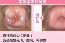 什么是子宫颈纳氏囊肿,成因、症状与防治策略